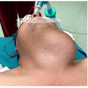 SANITÀ: A MESTRE ASPORTATA UNA TIROIDE DI QUASI UN KG 